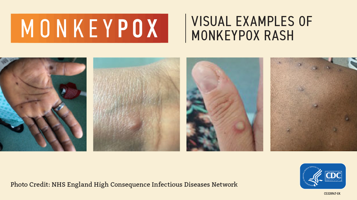 CDC Visual Examples of Monkeypox: Four different images of what Monkeypox looks like